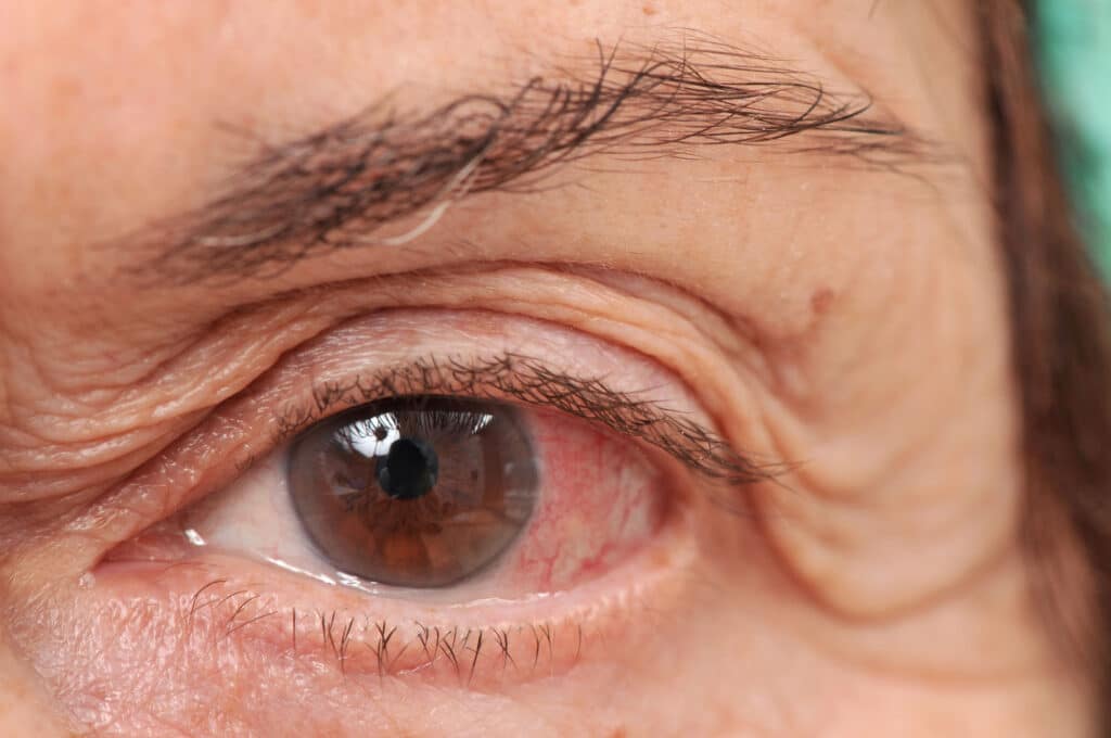 Senior home care can helps seniors with vision issues and symptoms so they can age in place safely.